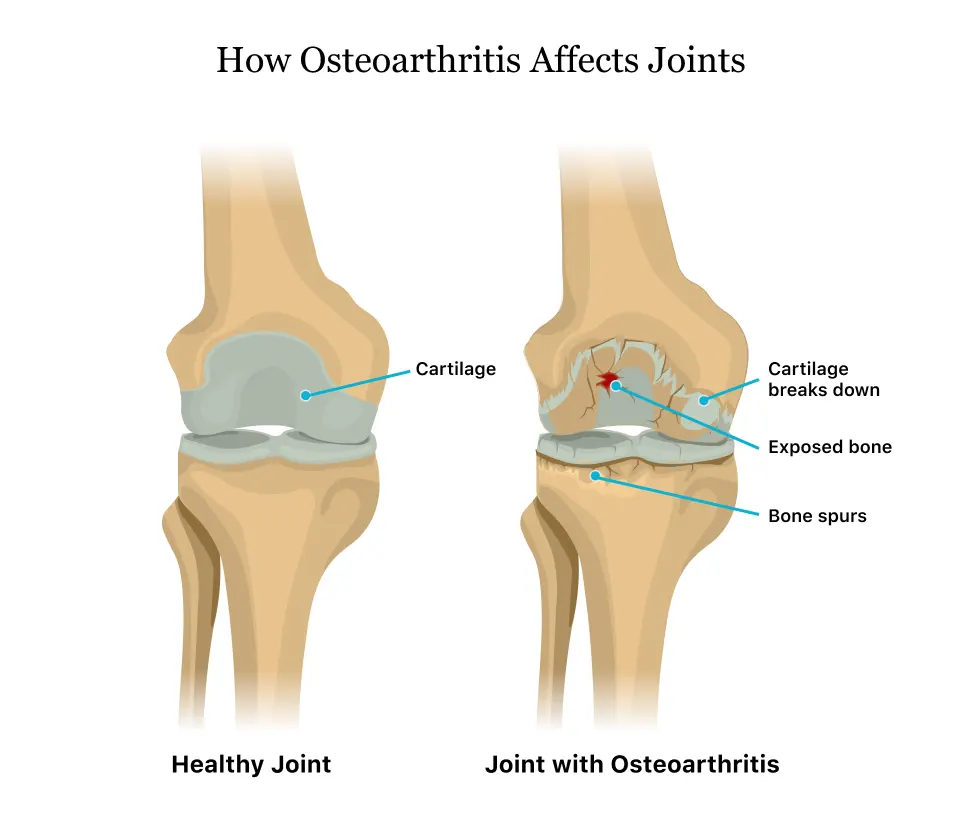 Osteoarthritis Treatment Clinic