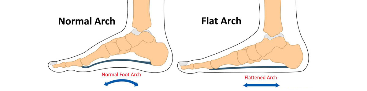 Pes planus or flat feet