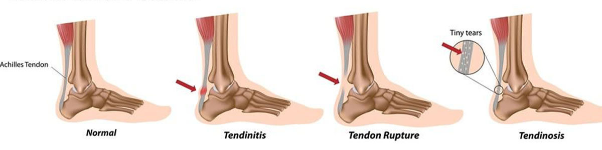 insoles for treat Achilles Tendonitis